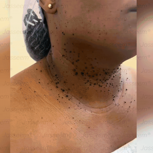 𝐉𝐚𝐬𝐬𝐞𝐞𝐦® Caneta laser para correção da pele