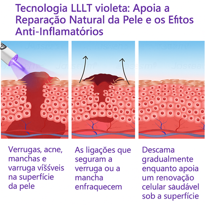 𝐉𝐚𝐬𝐬𝐞𝐞𝐦® Caneta laser para correção da pele