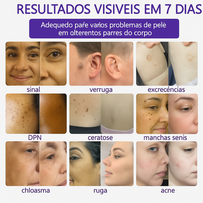 𝐉𝐚𝐬𝐬𝐞𝐞𝐦® Caneta laser para correção da pele