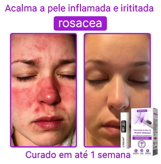 𝐉𝐚𝐬𝐬𝐞𝐞𝐦® Caneta laser para correção da pele