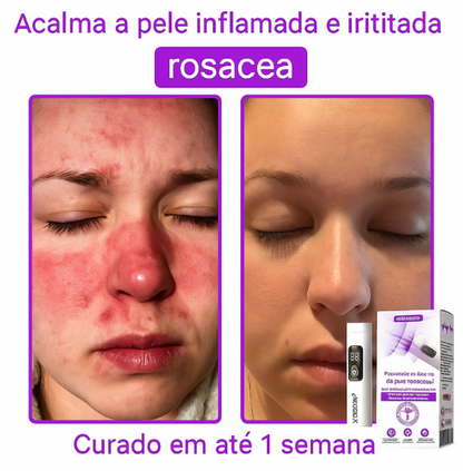 𝐉𝐚𝐬𝐬𝐞𝐞𝐦® Caneta laser para correção da pele