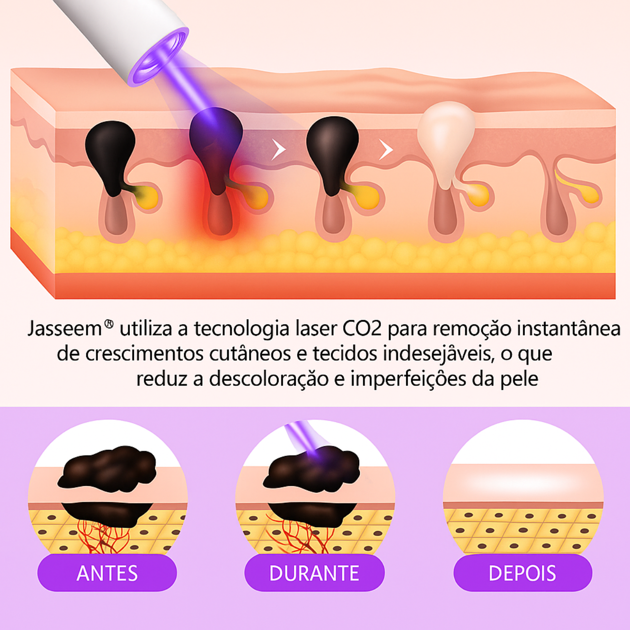 𝐉𝐚𝐬𝐬𝐞𝐞𝐦® Caneta laser para correção da pele
