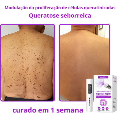 𝐉𝐚𝐬𝐬𝐞𝐞𝐦® Caneta laser para correção da pele